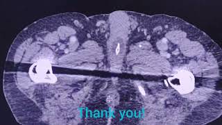 Malposition of Folley catheter  the importance to check   CT findings [upl. by Auqenahs]