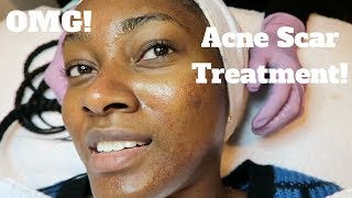 My Dermatology Acne Scar Treatment  Microneedling Experience [upl. by Bertrand]