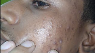 sac be spa blackheads elderly 2024  sac be spa old age blackheads 2024  sac be spa face scrub 882 [upl. by Jahdiel]