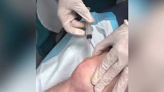 Draining of knee bursis [upl. by Avrit314]