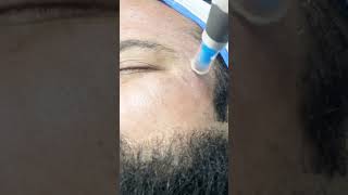 Dermapen Microneedling for acne scars  Dermalyn Aesthetics  Dr Muskan Tyagi [upl. by Debbie]