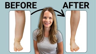 The Best Leg Lymphedema Treatment [upl. by Eelyrag319]