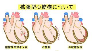 拡張型心筋症について解説しました [upl. by Saberio]