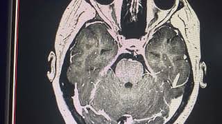 Vasculitis cerebral neuritis óptica crónica [upl. by Lara]