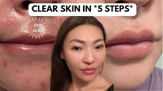 5 Step Acne Skincare Routine AM amp PM  How I Got Rid of Acne Scars Texture 2024 [upl. by Marietta]