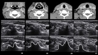 ENGNeck anatomy4lateral [upl. by Wolpert]