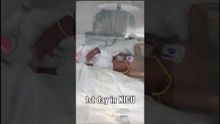 Extreme premature 24 weeks baby New born NICU [upl. by Limoli]