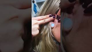 Squeeze ear pit for one day ear sinus preauricular sinus pimplepopping piercing [upl. by Zerat]