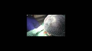 Sistrunk Surgery for Thyroglossal cyst [upl. by Nitsug]