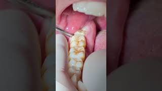 Wisdom tooth extraction dentist dental dentistry [upl. by Kevon]