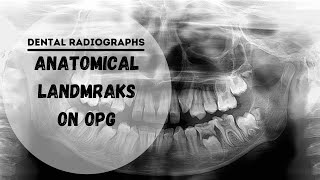 Dental panoramic radiographs  OPG  DPT Anatomical Landmarks [upl. by Ralleigh]