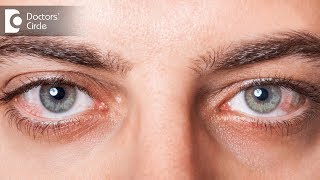 Causes of Red eye  Dr Mala Suresh [upl. by Florentia]