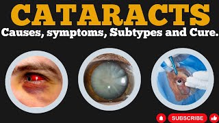 5 Surprising Causes and Treatments for Cataracts Revealed [upl. by Ayna]