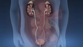 Shockwave Lithotripsy [upl. by Sarson867]