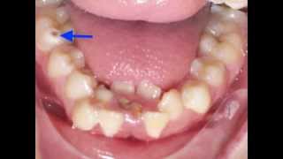 Lower Incisor Extraction Time Lapse Video Kyger Orthodontics [upl. by Atirihs]