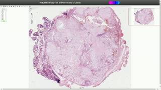 Pleomorphic Adenoma  Histopathology [upl. by Trout476]