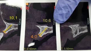 Dental Volimetrik Tomografi Nedir  Nasıl Okunur [upl. by Guidotti]