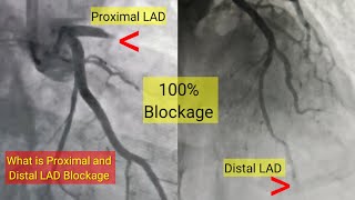 What is proximal and Distal LAD artery Blockage and Treatment l हार्ट ब्लॉकेज और ईलाज [upl. by Claybourne125]