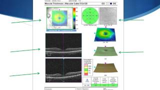 OCT Tutorial On Interpreting Cirrus OCT Macular Scans [upl. by Reuven369]