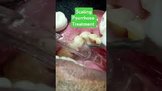 Pyorrhoea Treatment Deep Scaling n Curettage smile dentistry dentist aligner dentalclinic [upl. by Waxman858]