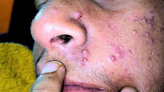 sac be spa blackheads elderly 2024  sac be spa old age blackheads 2024  sac be spa thuy 965 [upl. by Etnahsa909]