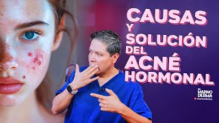 CAUSAS Y SOLUCIÓN DEL ACNÉ HORMONAL [upl. by Hokanson]