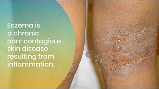 Treating and Managing Eczema in All Skin of Colors [upl. by Ettessil]