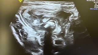 Ultrasound of Ruptured appendix fecolith  collection Apndx covred wid bowel loop lump [upl. by Hatnamas]