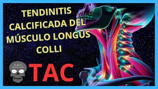 TENDINITIS Calcificada del Músculo LONGUS COLLI en TOMOGRAFÍA [upl. by Marian]