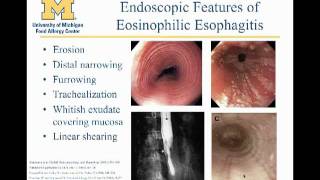 Eosinophilic Esophagitis Matthew Greenhawt MD [upl. by Nohs]