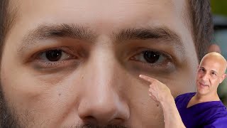 1 Vitamin to Remove Dark Circles  Dr Mandell [upl. by Aerdnaid]