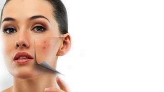 How To Treat Acne Scars  Expert Advice  Post Acne Skin Care  Glamrs [upl. by Llenrad621]