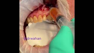 Aspirating a Radicular Cyst [upl. by Llenoj79]