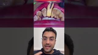 DENTISTA reage a DENTE MOLE [upl. by Kinimod]