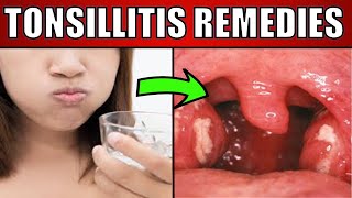 Tonsillitis HOME Remedies and Cures for Fast TREATMENT [upl. by Nohtanoj]