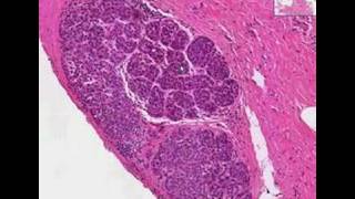 Histopathology BreastLobular carcinoma in situ [upl. by Ire881]