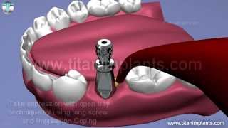 Open tray impression technique with final restoration for Internal Triangle [upl. by Philipa]