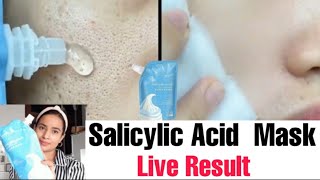 Salicylic Acid Ice Cream Mask Removeopen porse Acne  Pimples Black Heads  Honest Review  Demo [upl. by Annahsat]