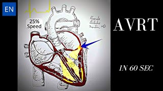 Atrioventricular Reentrant Tachycardia AVRT Animation and ECG Shorts [upl. by Lodmilla821]