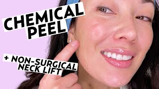 Getting a Vi Peel Chemical Peel amp NonSurgical Neck Lift  Skincare with Susan Yara [upl. by Ahsina]