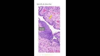 Exam slides squamous epithelial lesions set 21 Dr GSS SRM MCH RC [upl. by Britt667]