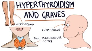 Understanding Hyperthyroidism and Graves Disease [upl. by Olivia]