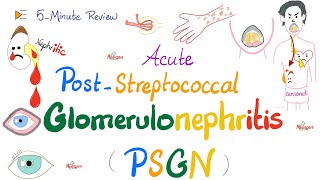 Acute PostStreptococcal Glomerulonephritis APSGN Nephritic Syndrome Kidney PathologyNephrology [upl. by Trilby]