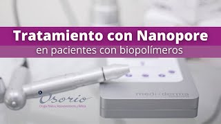 Tratamiento con Nanopore en pacientes con Biopolímeros [upl. by Ahsik733]