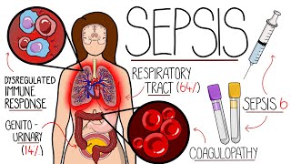 Understanding Sepsis Sepsis Explained Clearly [upl. by Lipman874]