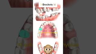 Second premolars extraction orthodontie kieferorthopädie orthodontics ortodonzia ortodoncia [upl. by Gladys996]