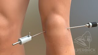 Knee Arthroscopy Animated Video [upl. by Sharp]