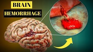 Brain Hemorrhage Causes Symptoms Treatment and Prevention [upl. by Alyosha]