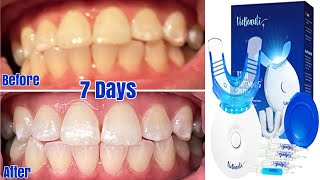 VieBeauti Teeth Whitening System Unboxing Review 7 Days Later [upl. by Sedecram]