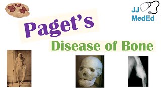 Paget’s Disease of Bone Osteitis Deformans  Causes Pathogenesis Symptoms Diagnosis amp Treatment [upl. by Tillio]